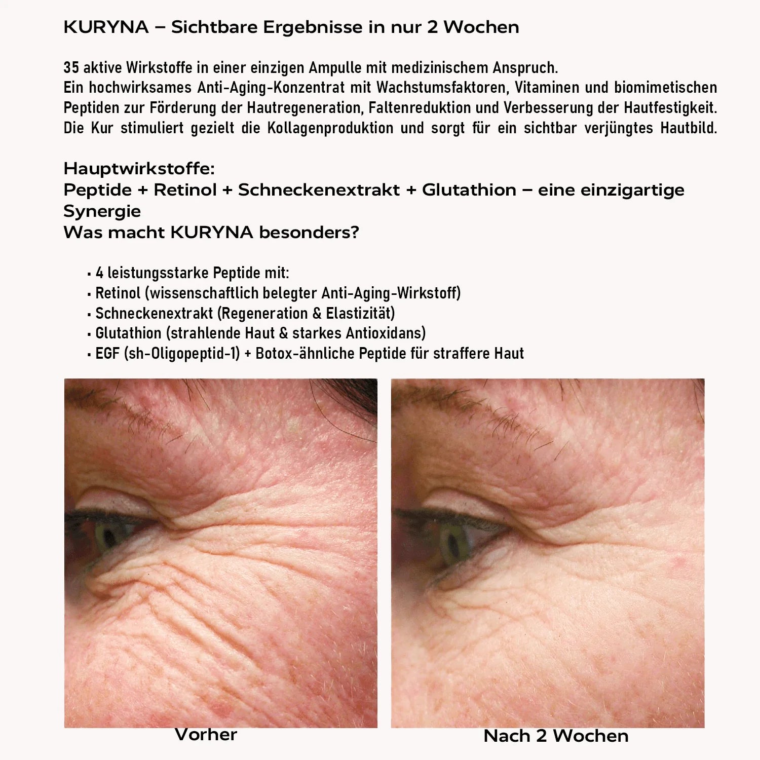 AquaGold® Microneedling Treatment